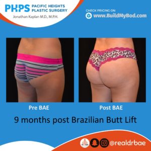 Brazilian Butt Lift with Implants vs Fat, Plastic Surgeon San Francisco