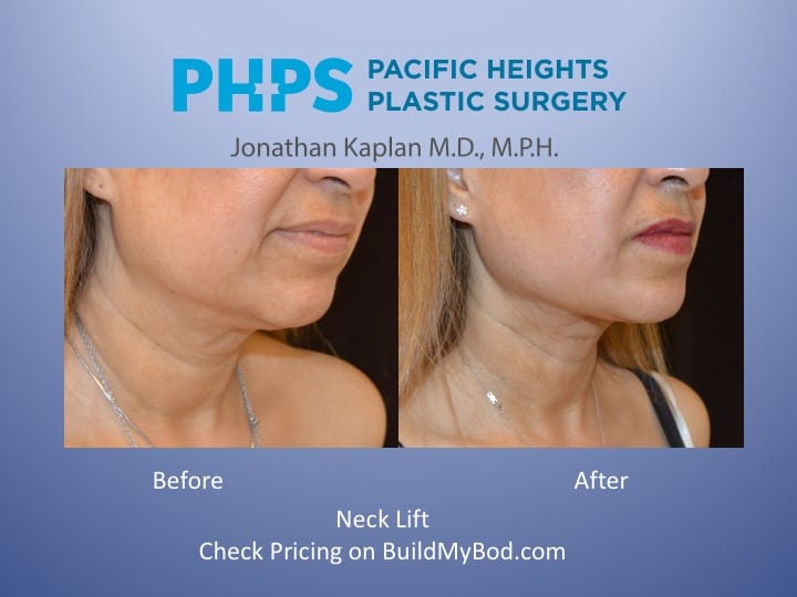 Necklift 3 Quarter Before And After Plastic Surgeon San Francisco Pacific Heights Plastic